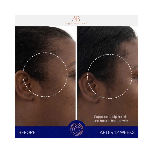 Augustinus Bader The Scalp Treatment (30 ml) - Augustinus Bader