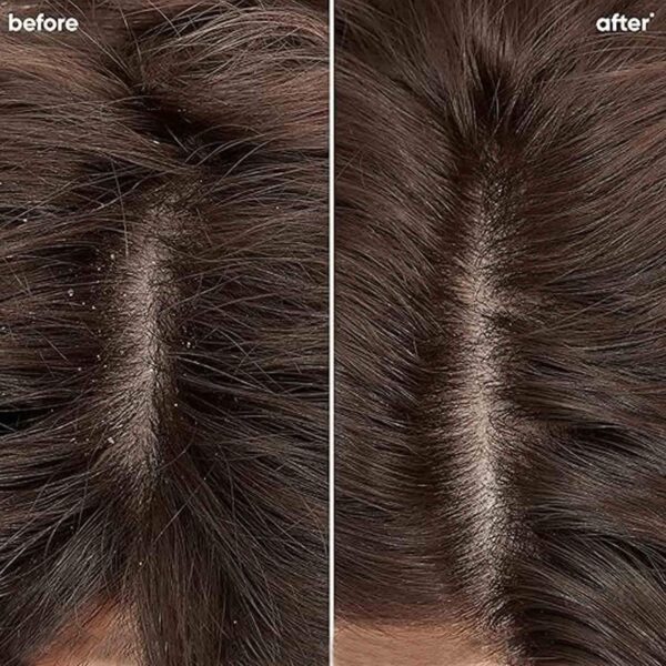 Biolage Scalppure Shampoo & Conditioner Combo, Removes Flakes from 1st Wash (200 ml + 98 g) - Biolage