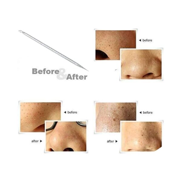 Bronson Professional Black Head Remover Tool - Pointed (1Pc) - Bronson Professional