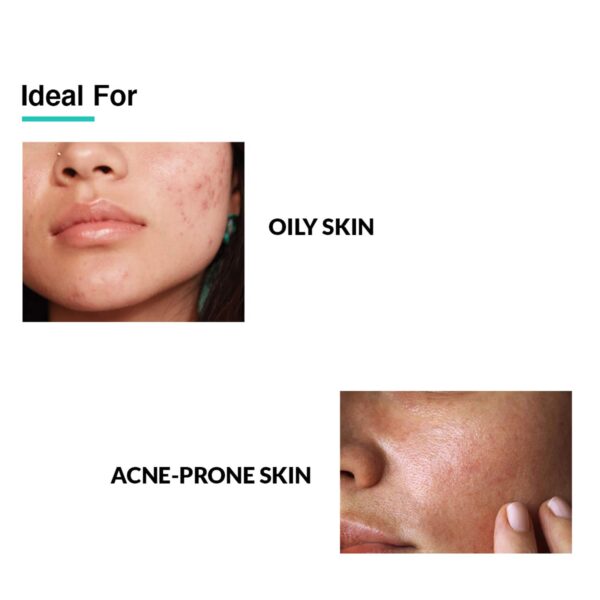 Fixderma 2% Salicylic Acid Serum for Anti Acne Treatment with 5% Azelaic Acid & 4% Mandelic (30 g) - Fixderma