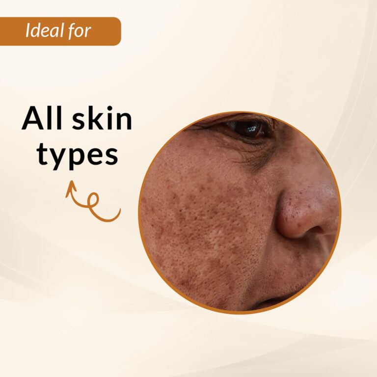 Fixderma Skarfix Plus Cream (15g) - Fixderma