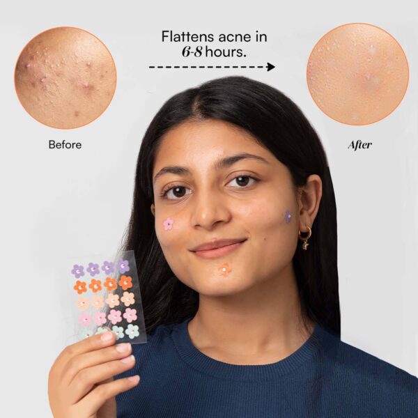 Gush Beauty Dart It Hydrocolloid Pimple Patches for Healing Acne, Zits and Blemishes - Flower - Gush Beauty