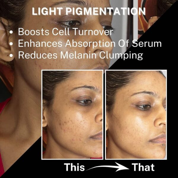 House of Beauty Derma Roller 0.50mm Reduces Pigmentation, Fade Pimples & Acne Scars (1 Pc) - House of Beauty
