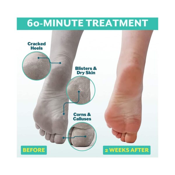 Patchology Poshpeel Pedi Cure Treatment - Patchology