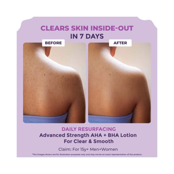 Sanfe Clear & Confident Glycolic Acid And Daily AHA Lotion For Smooths Rough & Bumpy Skin (200ml) - Sanfe